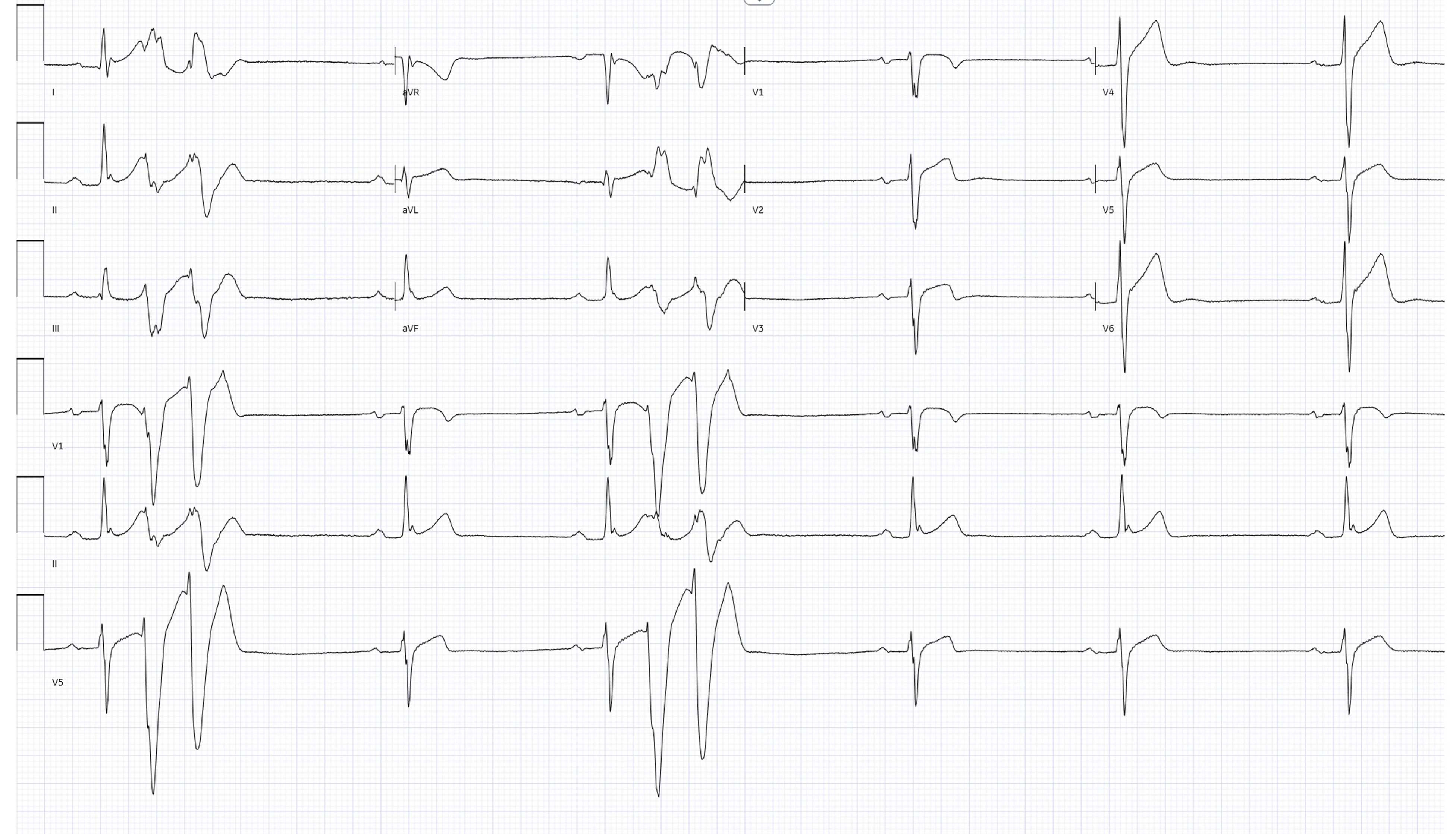 Typical Short-Coupled PVC of IVF