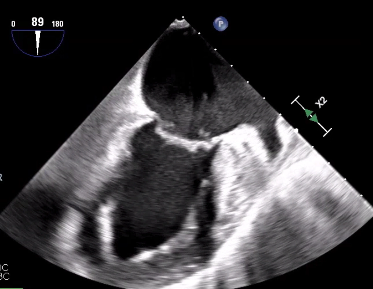 Image from a Trans-Oesophageal Echocardiogram