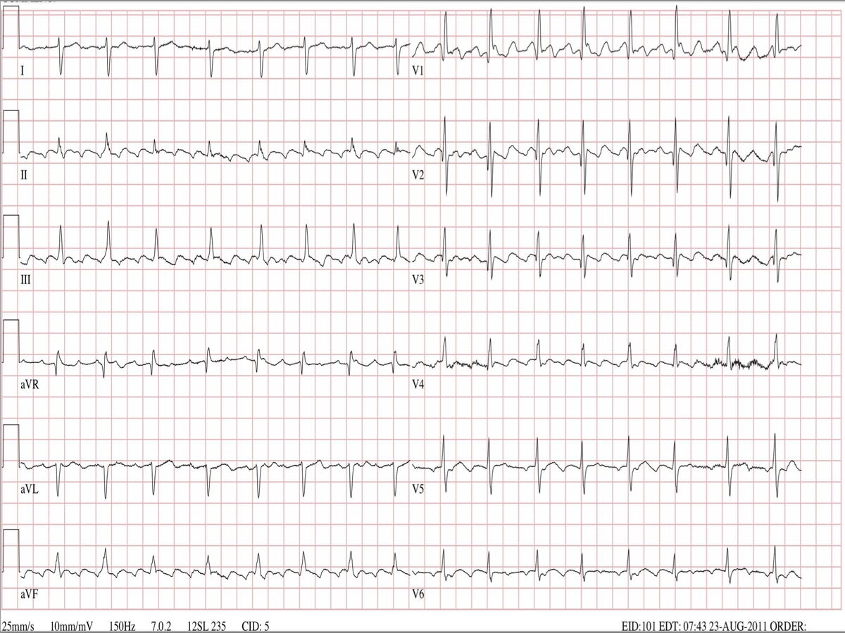 Typical Atrial Flutter on ECG