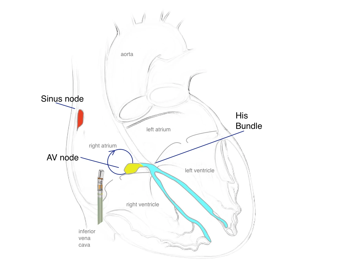 Catheter ablation of SVT. Ablation catheter is inserted through the inferior vena cava to the right atrium to treat a SVT circuit arising near the AV node