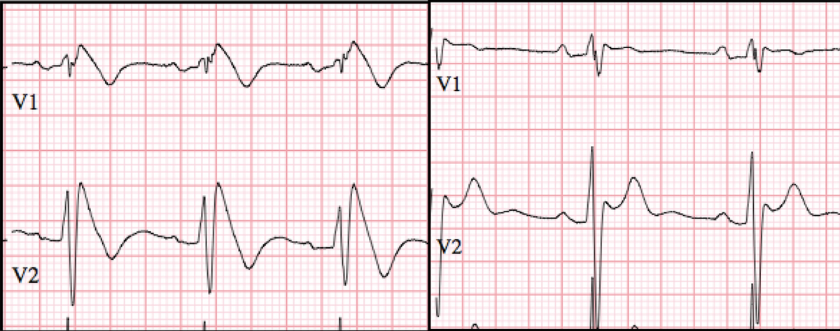 Image of Brugada Type I and Type II