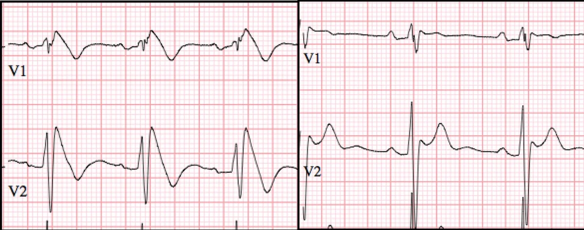 Brugada ECG Type 1 and 2 Image of Brugada Type I and Type II