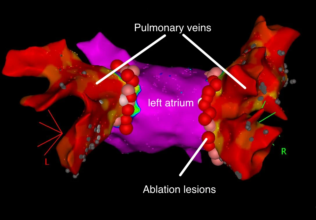 Radiofrequency Pulmonary Vein Isolation