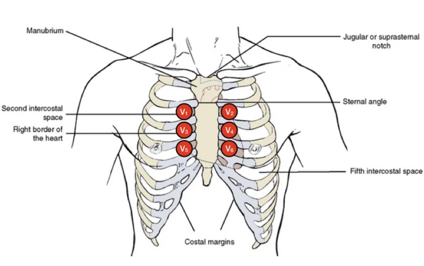 High Lead ECG Image showing the ECG positioning for a Brugada ECG
