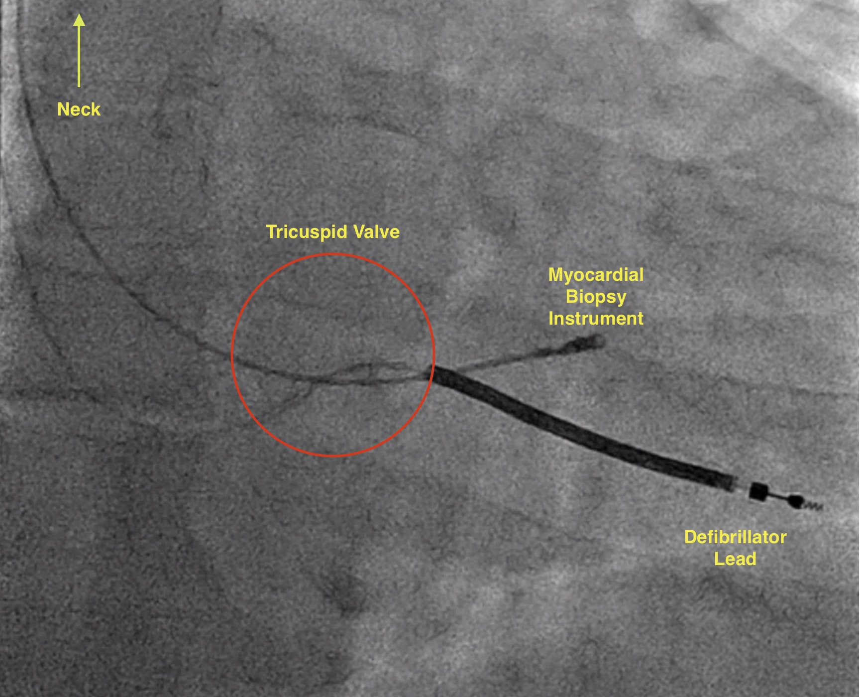 Myocardial Bioptome Biopsy in a patient with a Defibrillator