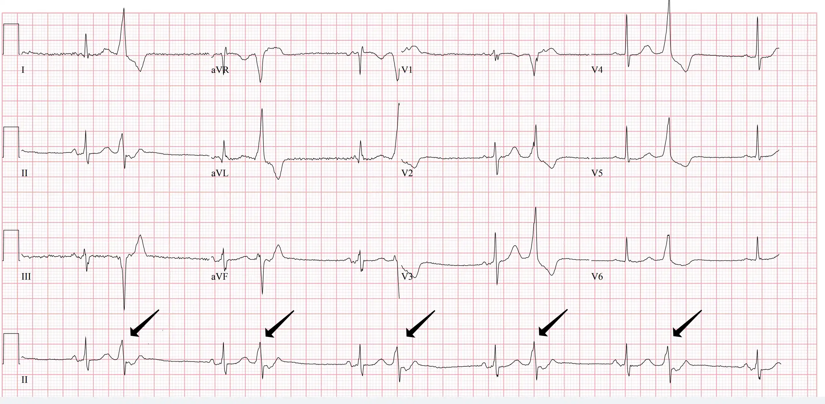 PVCs (arrow) Every Second Beat