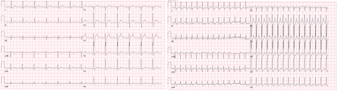 Normal ECG (left) and SVT (right) Image of Normal ECG and SVT