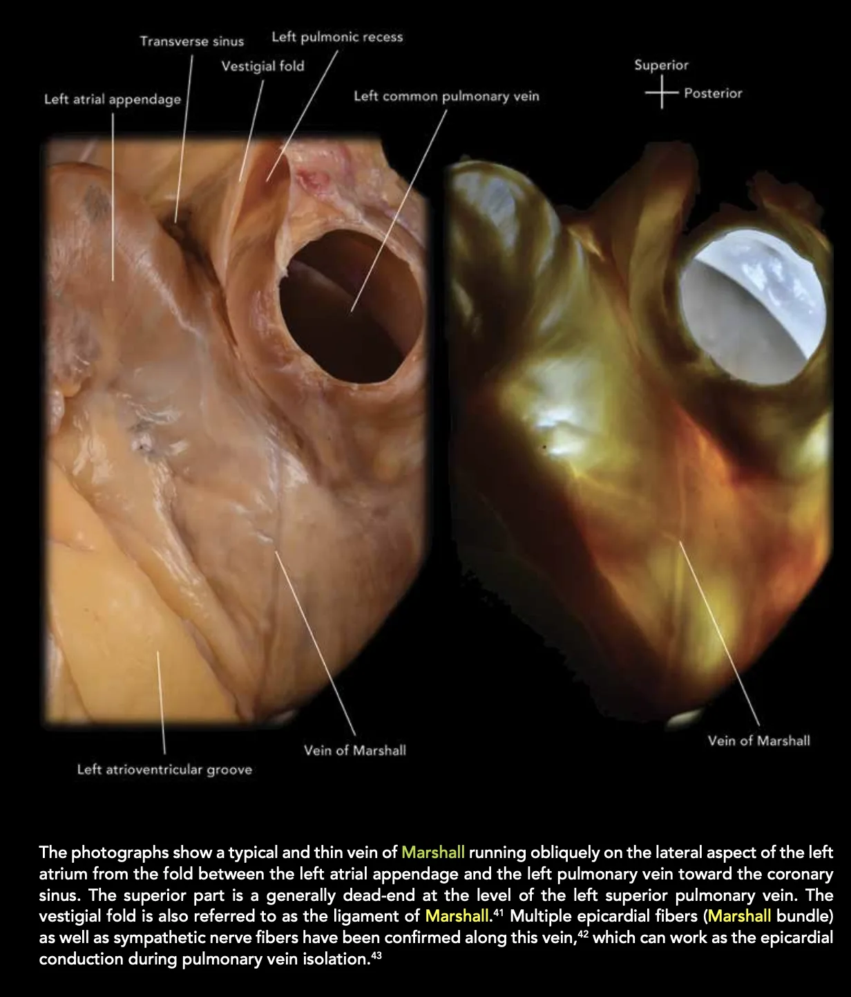 Anatomical photographs of the vein of Marshall running obliquely on the lateral aspect of the left atrium, from the fold between the left atrial appendage and the left pulmonary vein toward the coronary sinus
