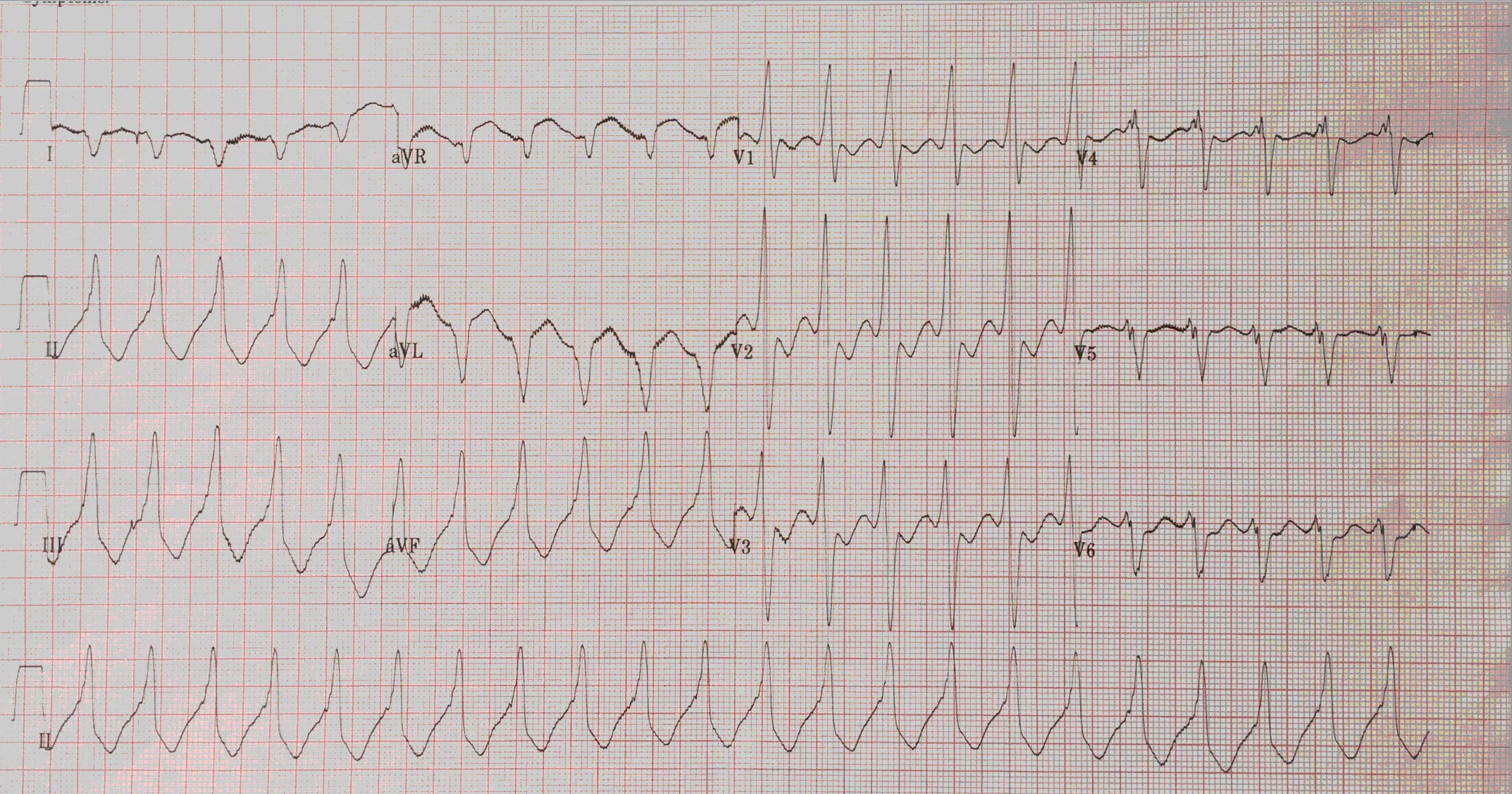 Ventricular Tachycardia (VT)